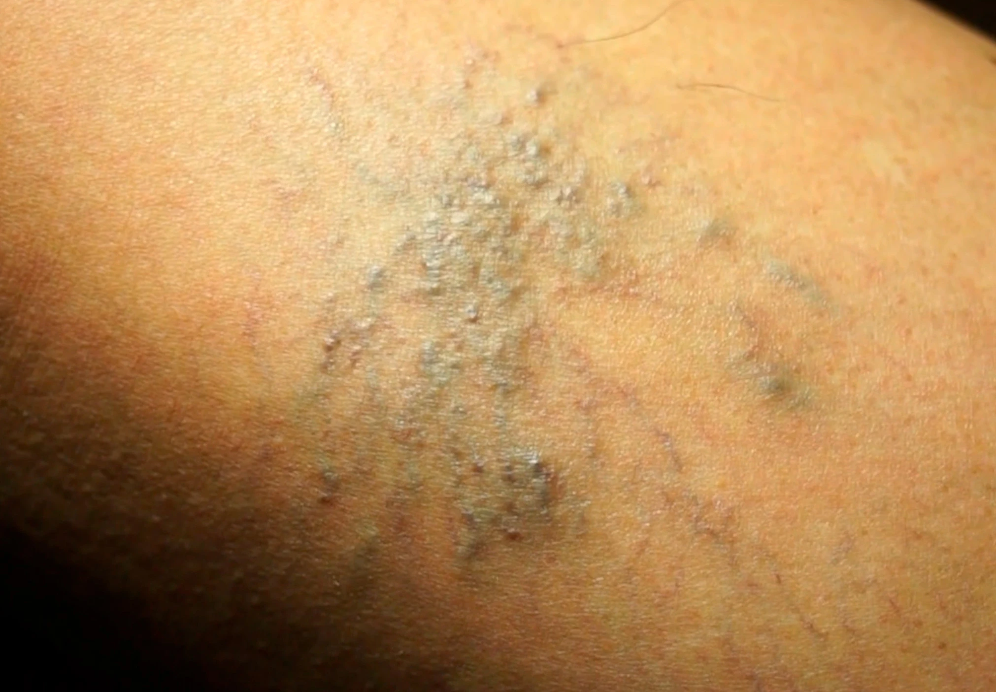 telangiectasias-arañitas-varices