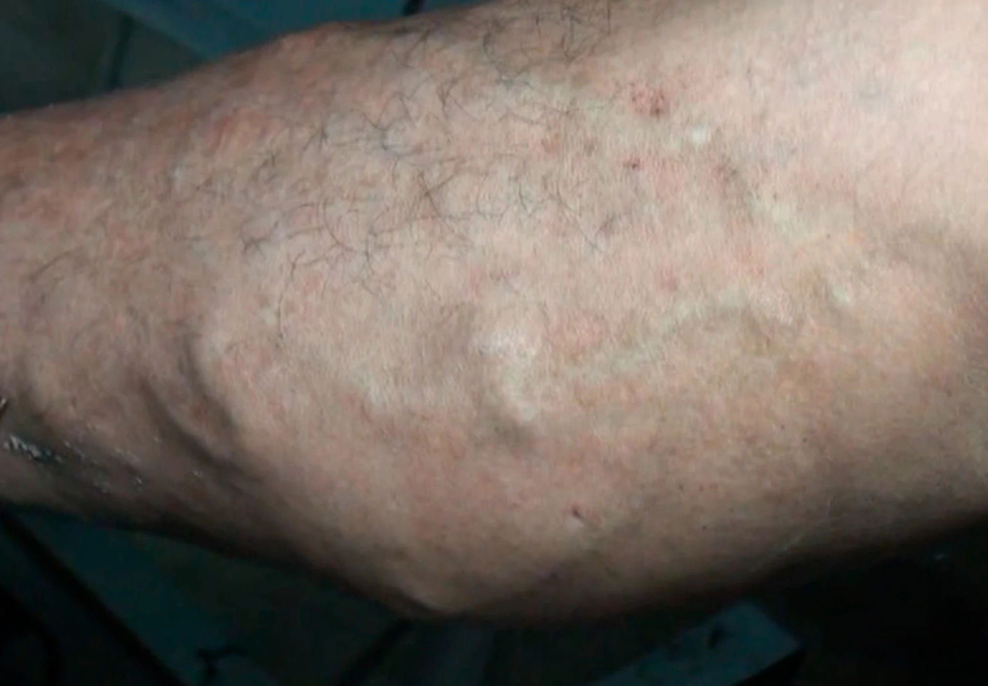 varices-gruesas