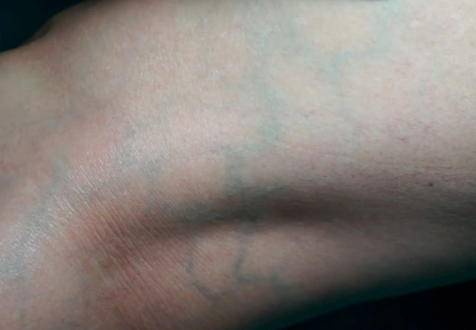 varices-reticulares